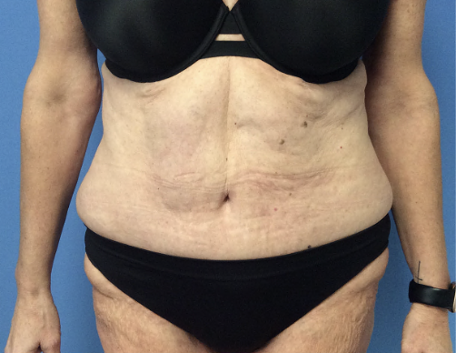 Tummy-Tuck--Case-Study-7318 | Before Body